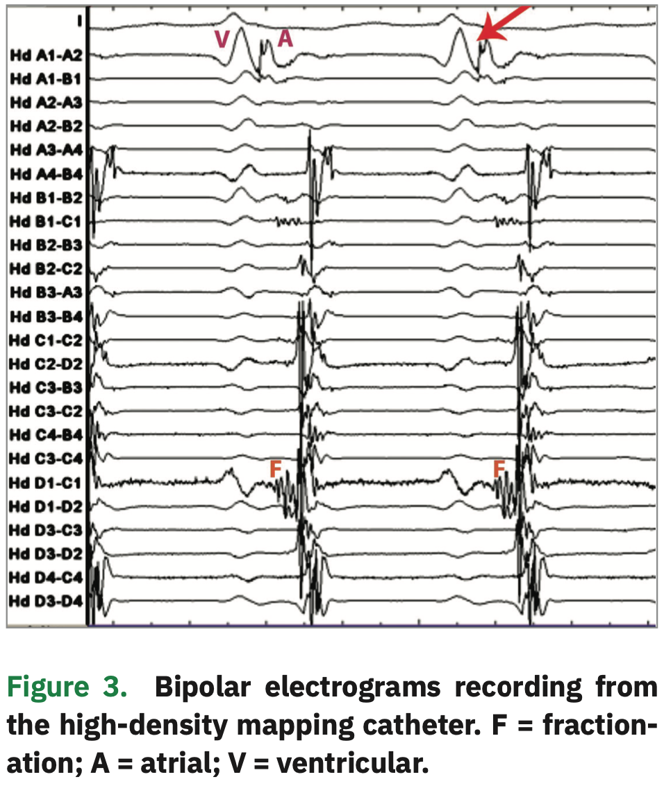 Mapping of a Left Lateral Accessory Pathway with a HighDensity